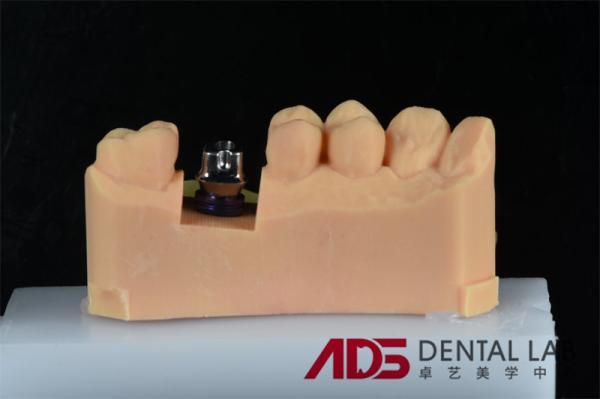 Dental Missing Teeth Cement Retained Implant Crown Replacement Custom
