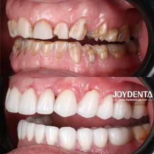 Dentaduras de zirconia que imitan los dientes naturales