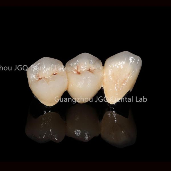 Customized Pfm Titanium Teeth Durable Corrosion Resistant Ensuring Longevity