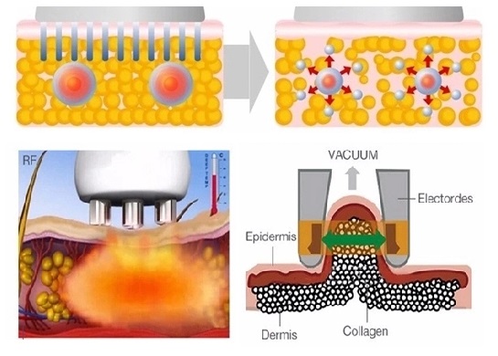Portable Weight Loss Flaccid Skin Lipo Cavitation Machine