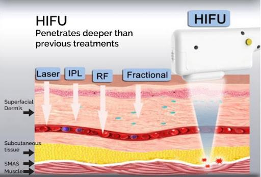 12D Ice Compress Anti Aging Ultrasound Focus For Skin Tightening And Aging Prevention