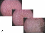 Машина лазера СО2 удаления пигментацией частичная для кожи Resurfacing 25W