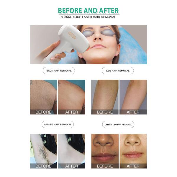 Утверждение CE ISO машины удаления волос супер боли клиники 808 лазеров свободное