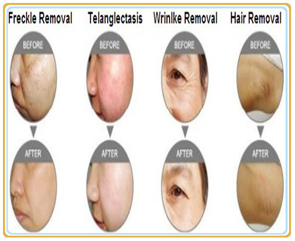 1200W E Light Ipl RF Beauty Machine для удаления волос на теле Пигмент Удаление