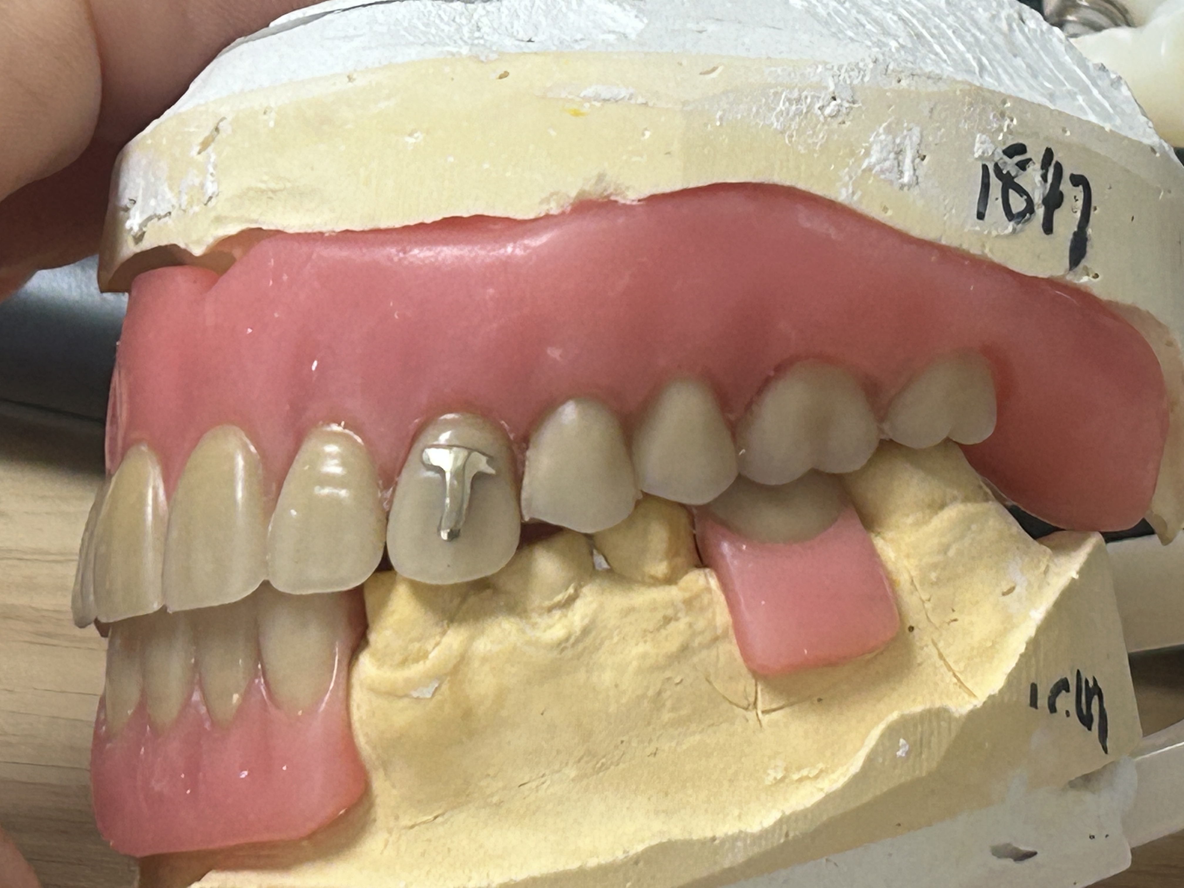 Customized Gold Teeth with Removable Denture