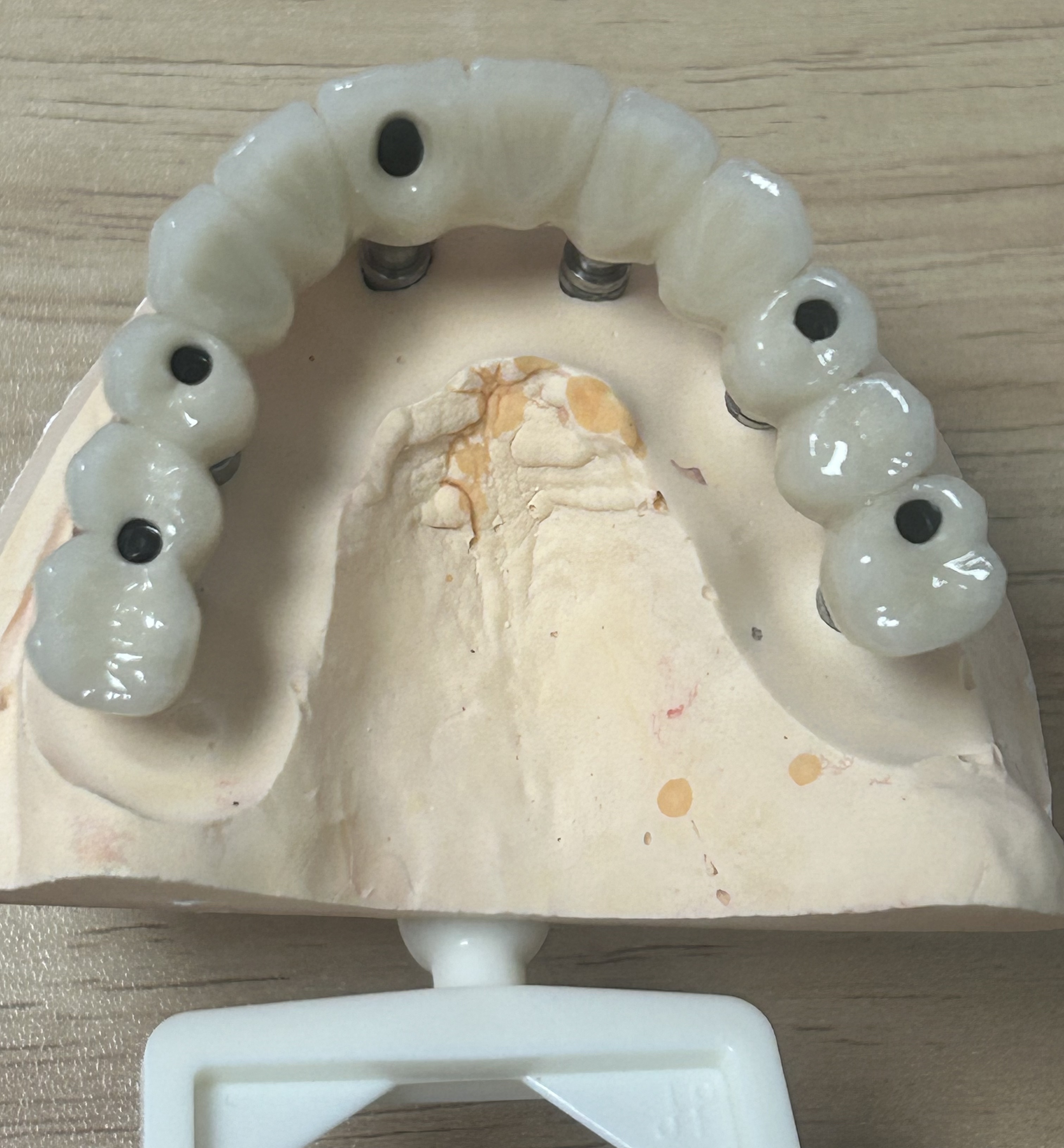High-Strength Dental Zirconia Implant Crown with Natural Translucency & Tooth-Like Appearance via Digital CAD/CAM
