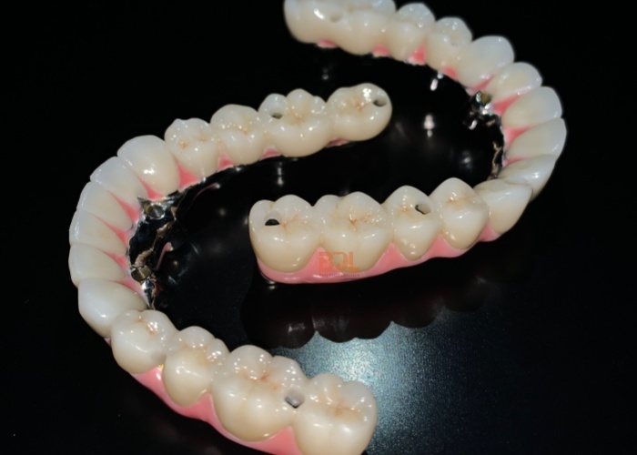 Titanium Custom Dental Implant Bar Engineered to Provide Superior Support and Stability for Dental Prosthetic Devices