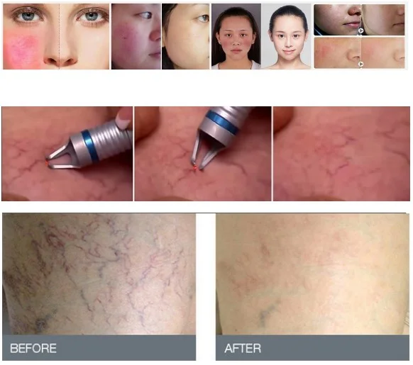 AC100-240V 15/30Hz 980 nm diode laser varicose veins removal machine