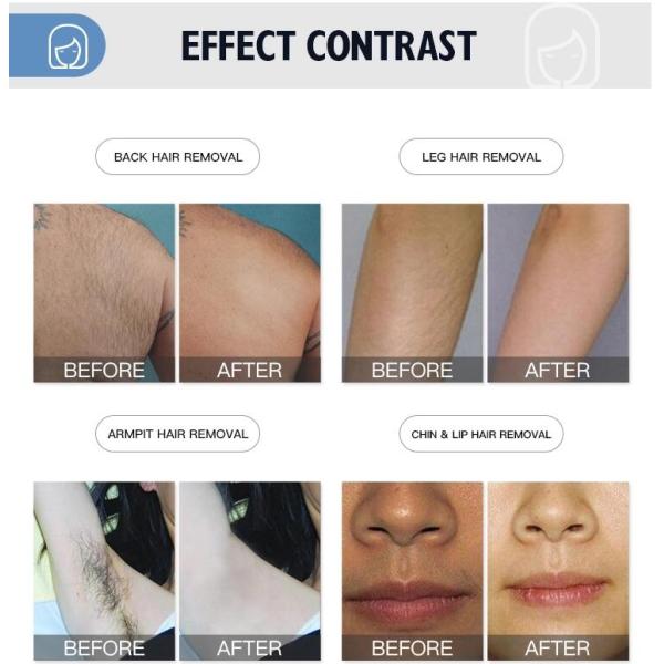 Micro Channel 808nm Diode Hair Removal Laser Machine With Germany Laser Bar