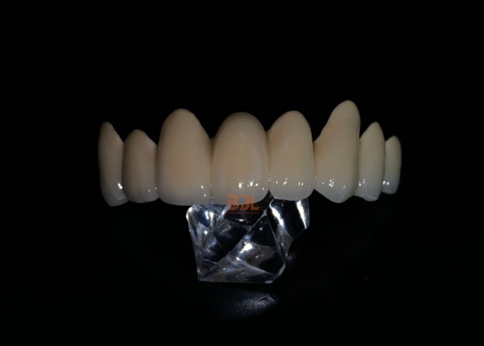 Durable Porcelain Fused To Metal Crown Dental Restoration Solution Ideal For Long Lasting Strength And Natural Appearance