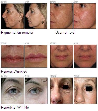 2017 New Arrivals USA RF Tube Fractional Co2 Laser For Skin Rejuvenation And Scar Removal