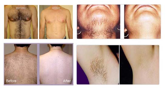 CE Approved Painfree Laser Hair Treatment Machine 808nm Used For Face Or Leg