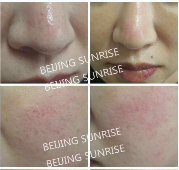 2016 new 980 nm laser spider veins removal Blood Vessels Removal
