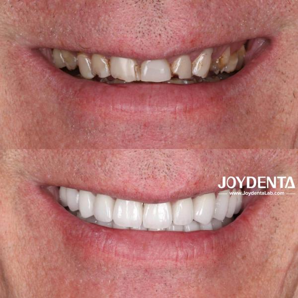 Prothèses en zirconium qui imitent les dents naturelles