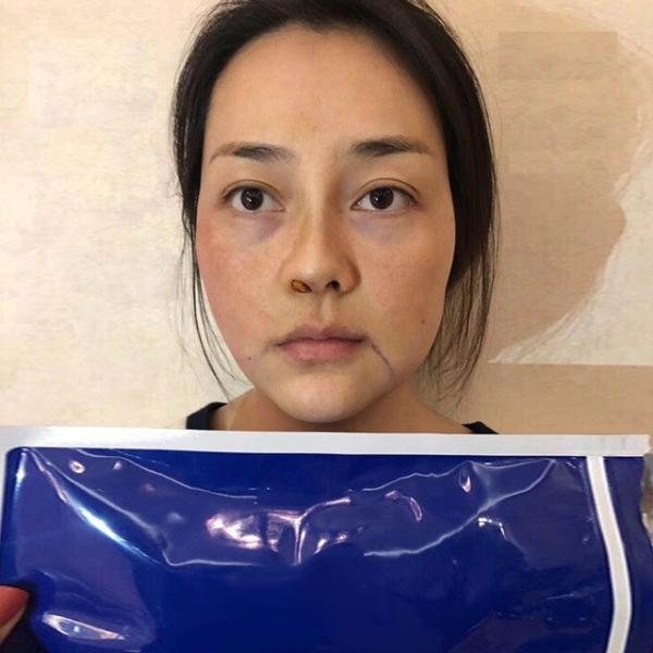 Mono 27G 50mm PDO Thread Face Lift For Medical Skin Tightening Lips Threads