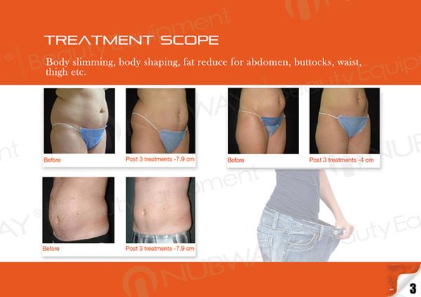 Non surgical Hifu body slimming machine for weight loss and body shaping