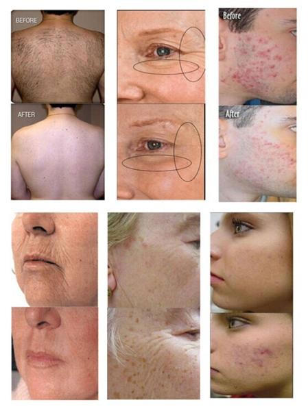E-light ipl rf system ipl shr hair removal machine male female permanent facial and body