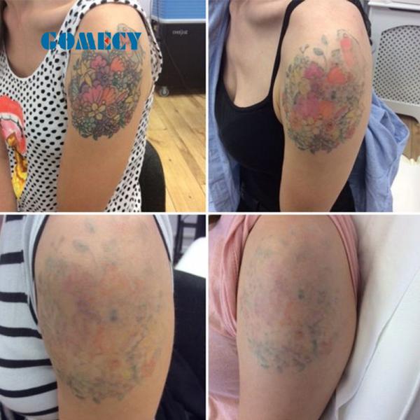 5 mm de tamaño de punto con láser Nd Yag 755nm con refrigeración por aire y agua