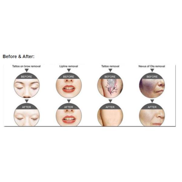 Professional Picolaser Picosecond Laser Q Switched ND YAG Laser Portable Tattoo Removal Carbon Peeling ND YAG Laser Machine Q Switched Erase Remove Color Tattoo