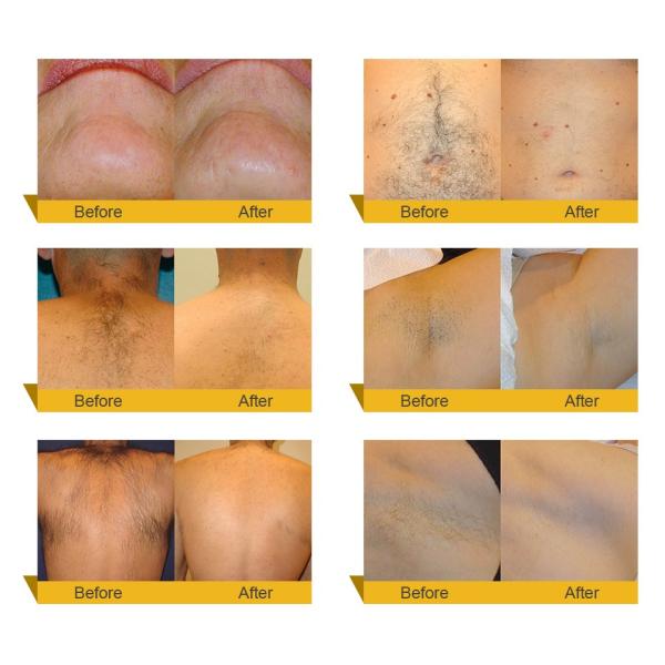 Professional Beauty Salon Device Hair Removal Q Switch Nd Yag Laser Beauty Machine