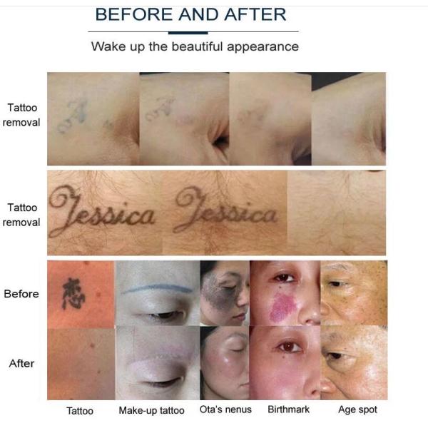 Portable Long Pulse Yag Laser Tattoo Removal Machine Painless For Beauty Salon