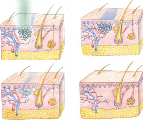 Mini Q Switch ND Yag Laser Tattoo Removal Machine