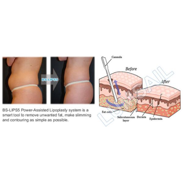 Safe Hip Power Assisted Liposuction Machine High Fluency For Fast Fat Cutting