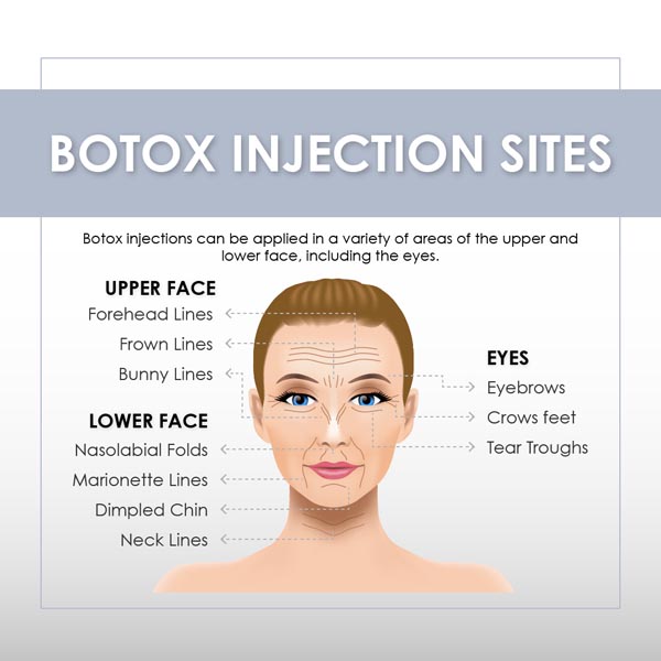 Токсин Botox блоков Hyamely 100 Botulinum к уменьшению морщинок лба