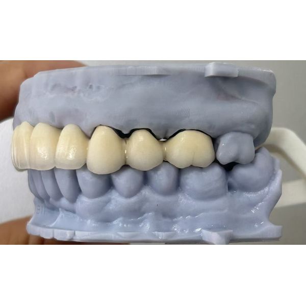 Semi-precious Porcelain Fused to Metal Dental Bridge for Durable Dental Restoration