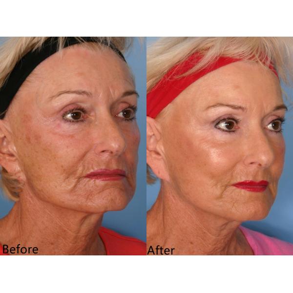 PLLA Инъекция для лифтинга лица 150 мг/ мл