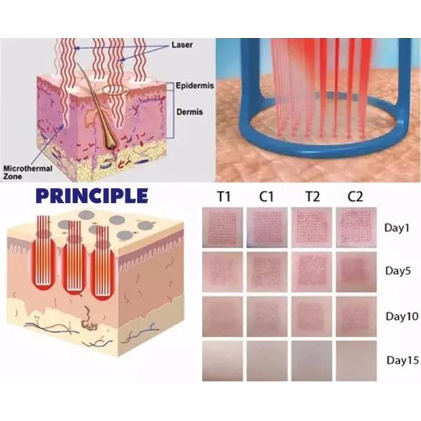 Настольный частичный затягивать кожи тела удаления шрама машины лазера