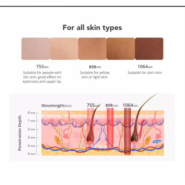 Machine d'épilation laser à diode de haute puissance portative 755 808 1064 nm 808 nm
