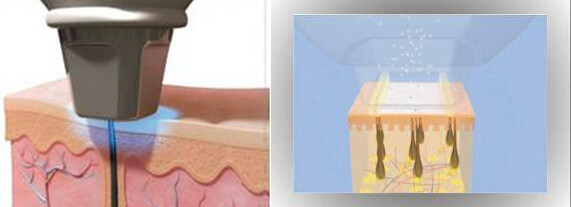 Máquina de remoção de pelos a laser de diodo médico para remoção da parte de trás da barba