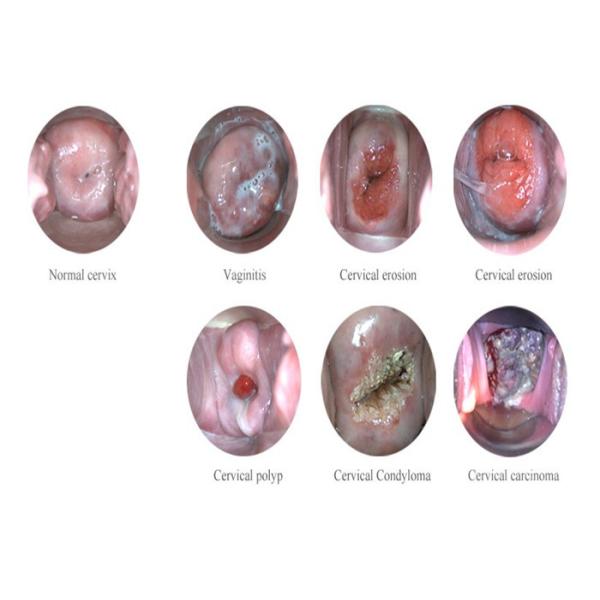 Портативный Само-Колпоскопе для Гынекологы подключенного с телевидением компьютера монитора