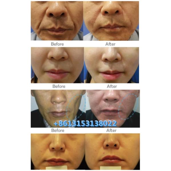 Dermal Hyaluronic Acid HA Filler Juvederm Voluma Ultra3 Ultra4