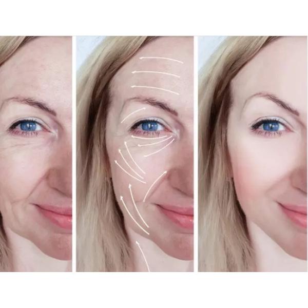 Проффило А Антимортический гиалуроновый кислотный дермальный наполнитель 2 мл х 1 шприц / коробка