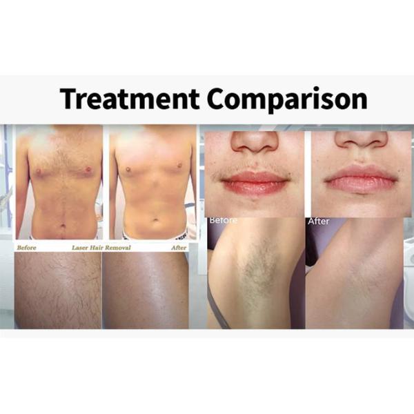 УПРАВЛЕНИЕ ПО САНИТАРНОМУ НАДЗОРУ ЗА КАЧЕСТВОМ ПИЩЕВЫХ ПРОДУКТОВ И МЕДИКАМЕНТОВ лазера диода 755nm 808nm 1064nm одобрило удаление волос лазера 808 диодов