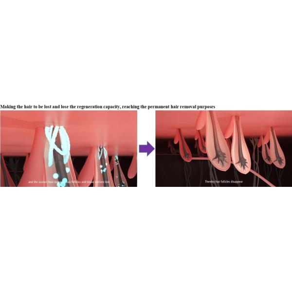 1064nm Laser Hair Removal Machine