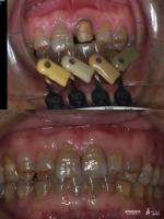 Coronas de zirconia translúcidas Tecnología de gradiente multicapa para una translucidez óptima y biocompatibilidad a largo plazo