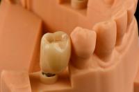 Internal Hex Connection Sandblasted Titanium Dental Implants Single Tooth Replacement