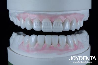 Highly Accurate Dental Restorations Wax Up In Dentistry 1-2mm Thickness