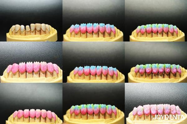 Ceramic For Natural Aesthetics Dental Veneers Stain Resistance Maintains Brightness Strong Bond With Tooth Enamel For Secure Fit