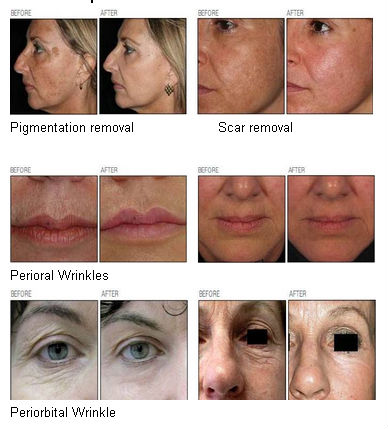 Fractional Co2 laser resurfacing machine