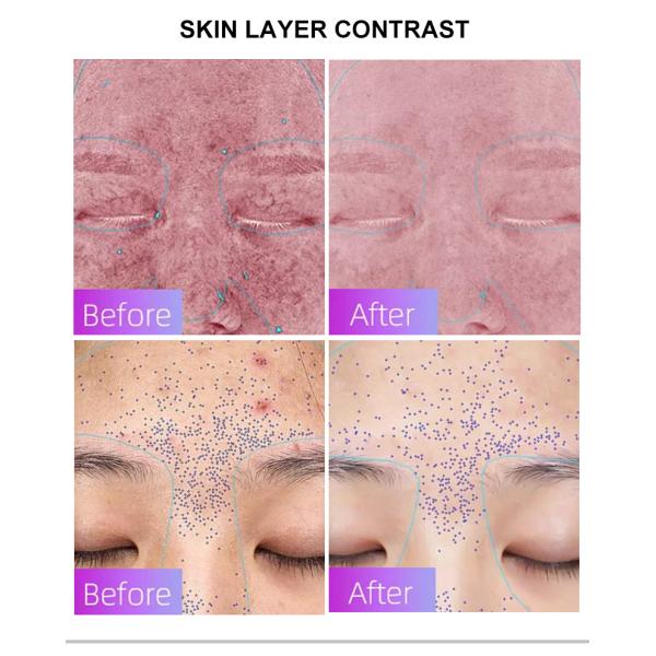 4 Color Light Silicone LED Light Face Therapy Mask for Acne Treatment Energy 46mv/cm2