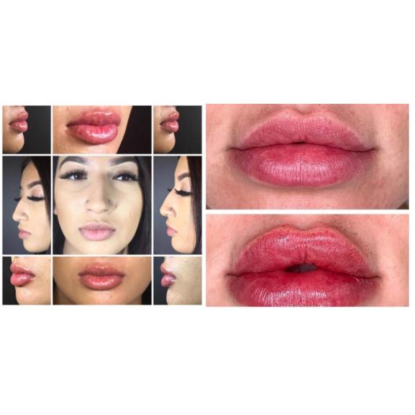 Заполнитель губ вводимого дермального заполнителя Skinject кисловочный Hyaluronic
