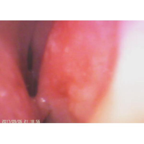 laryngoscope médical d'otoscope de caméra de gorge d'oreille de Digital d'écran d'affichage à cristaux liquides de 3,5 pouces