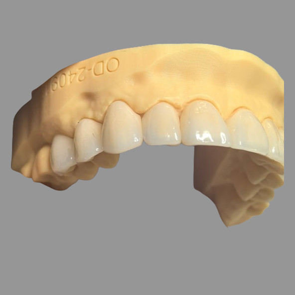 Smooth Pressed IPS EMax Crowns Staining Resistant Customizable