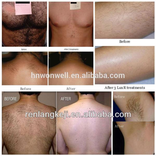 808nm Laser hair removal machine for beauty salon