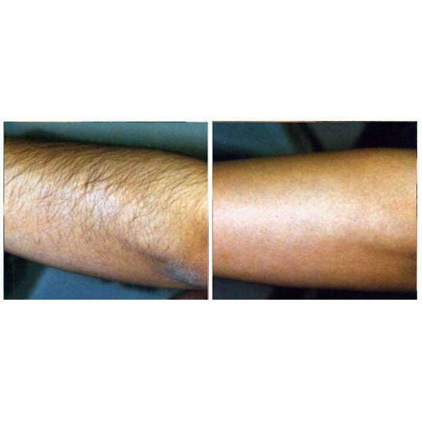 Skin Lightening Nd Yag Laser Hair Removal Machine Long Pulse 1064nm Wavelength