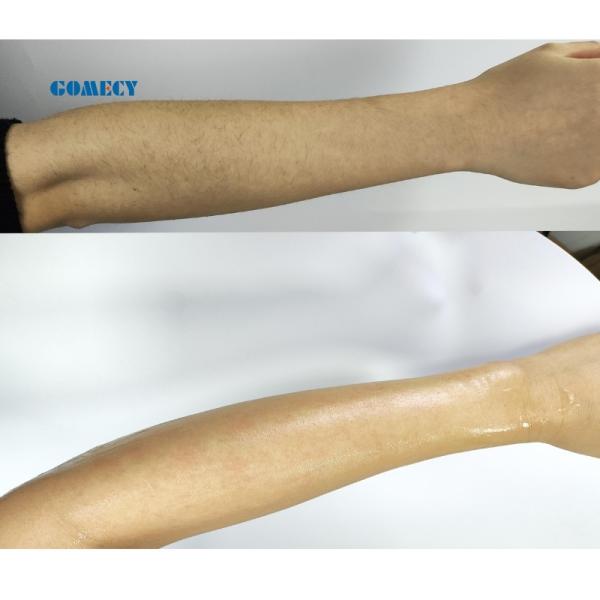 808 Diode Laser Hair Removal Machine Facial Skin Rejuvenation 808 755 1064Nm Laser Diode 808 Nm